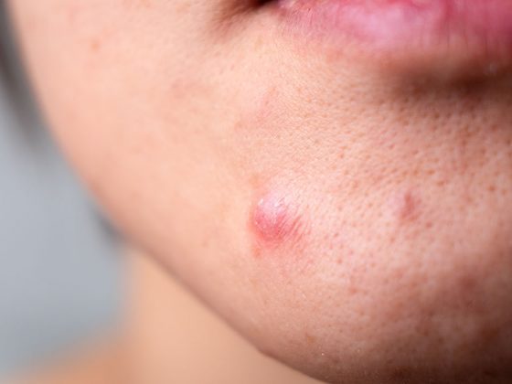 Ácido Mandélico: os benefícios do ativo aliado no combate à oleosidade e acne