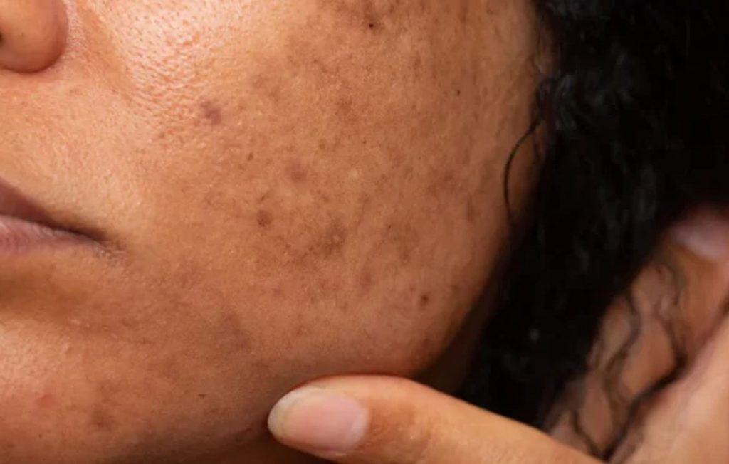 Como escolher um bom protetor solar para a pele com melasma?