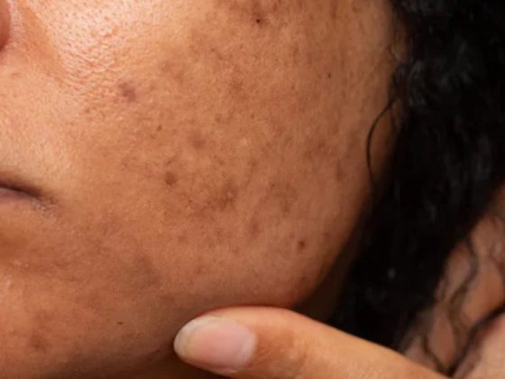 Como escolher um bom protetor solar para a pele com melasma?